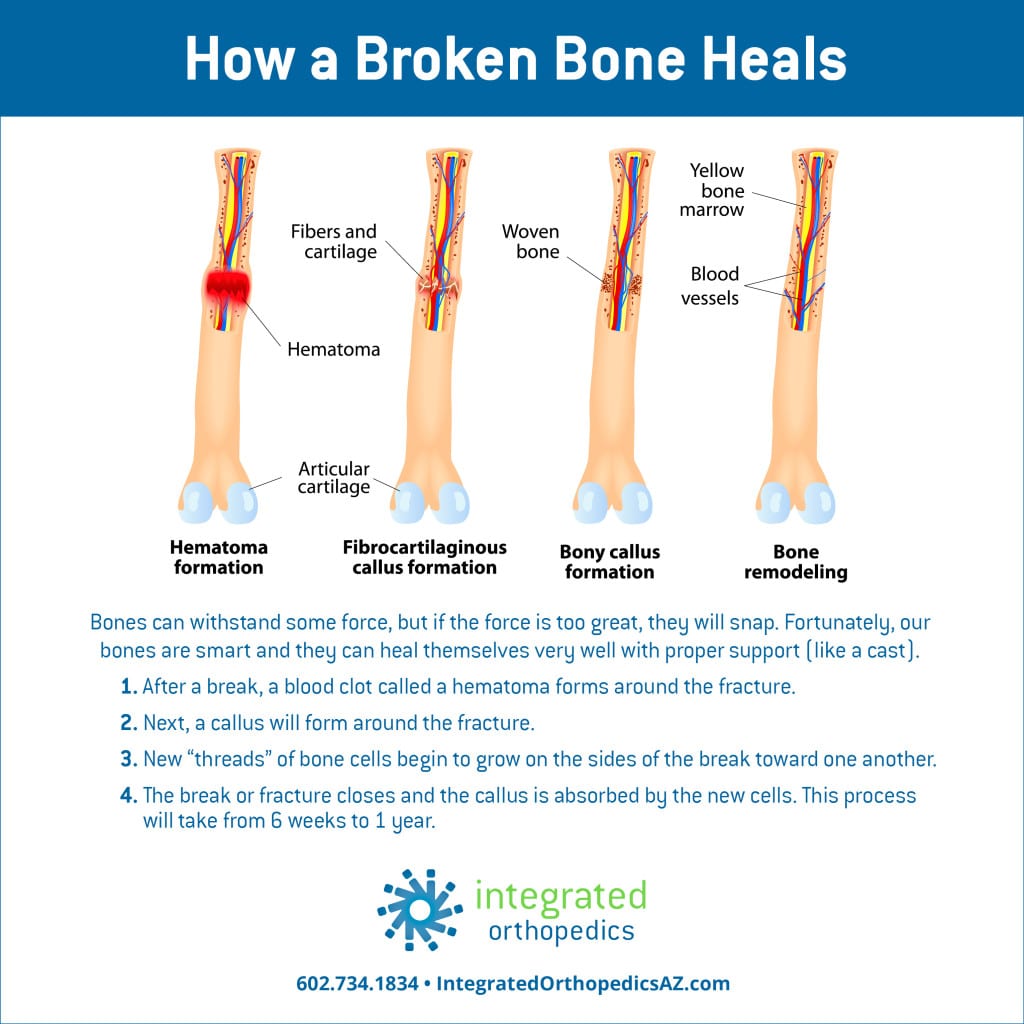 How a broken bone heals