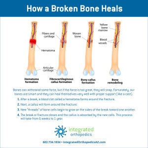How a Broken Bone Heals | Integrated Orthopedics