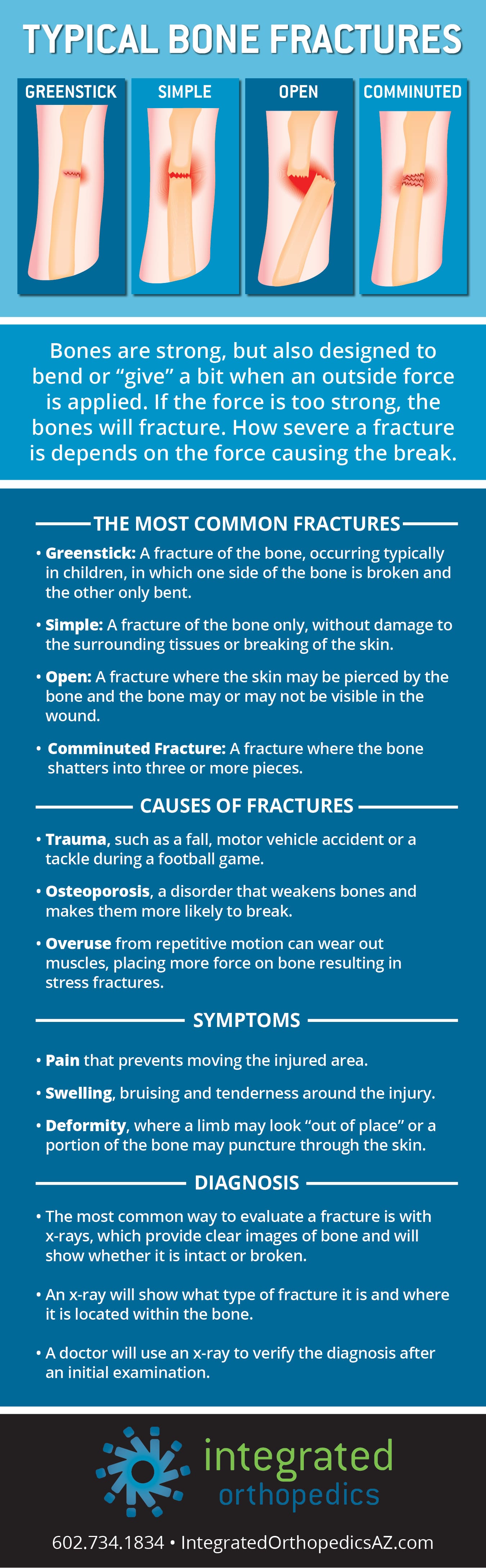 spiral fracture causes