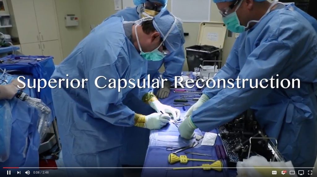 superior capsular reconstruction, SCR, shoulder surgery