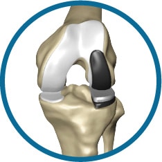 lateral knee replacement