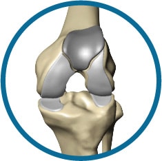Patellofemoral knee replacement