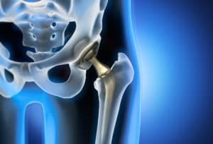 mako total hip replacement