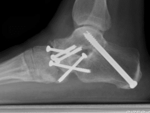 Total Ankle Replacement