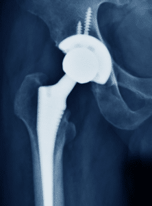 history of hip replacement