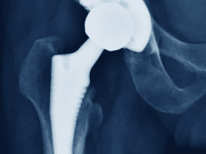 The History of Total Hip Replacement