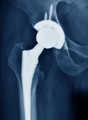 The History of Total Hip Replacement