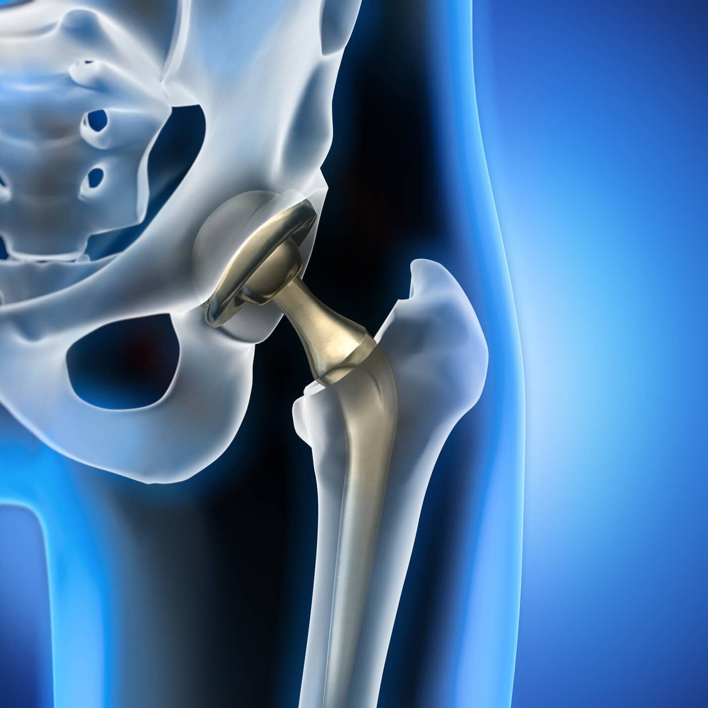 3d rendering of total hip replacement - medical illustration